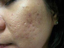 Acne Scarring Toronto | Best Acne Treatment