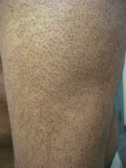 Keratosis Pilaris Treatment Reviews