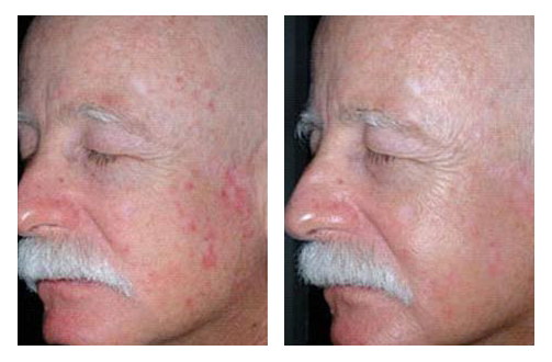 Actinic Keratosis (Solar Keratosis) in Adults: Condition ...