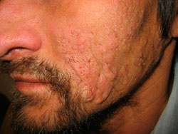 Acne Scarring 