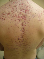 back acne
