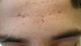 Scars from Acne on Forehead