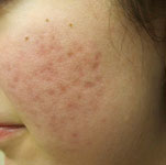 Acne on cheek and face area