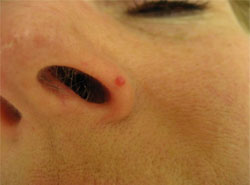 Angiofibroma: Symptoms, Causes, & Treatment - Toronto Dermatology Centre