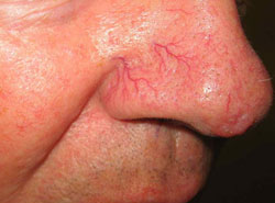 burst red capillaries on penis Burst red capillaries on penis