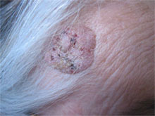 Seborrheic keratoses or 