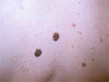 Seborrheic keratoses or 