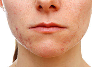 acne