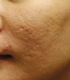 acne-scar-treatment-before-left-side