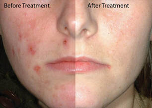 acne-before-and-after
