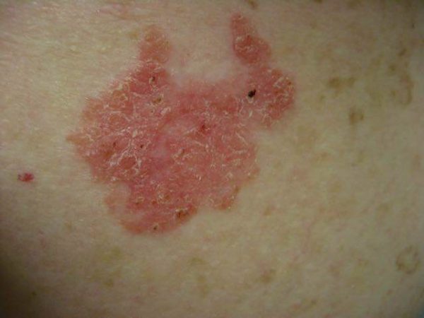 Diabetes risk increased in those with severe psoriasis - Toronto ...