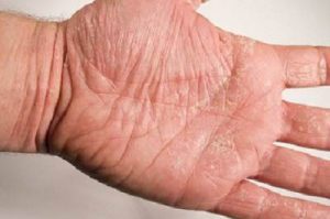 hand eczema