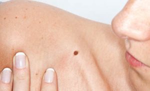 mole lesion spot on person's shoulder