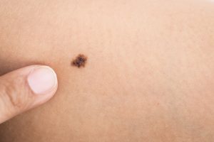 mole spot pigment on skin