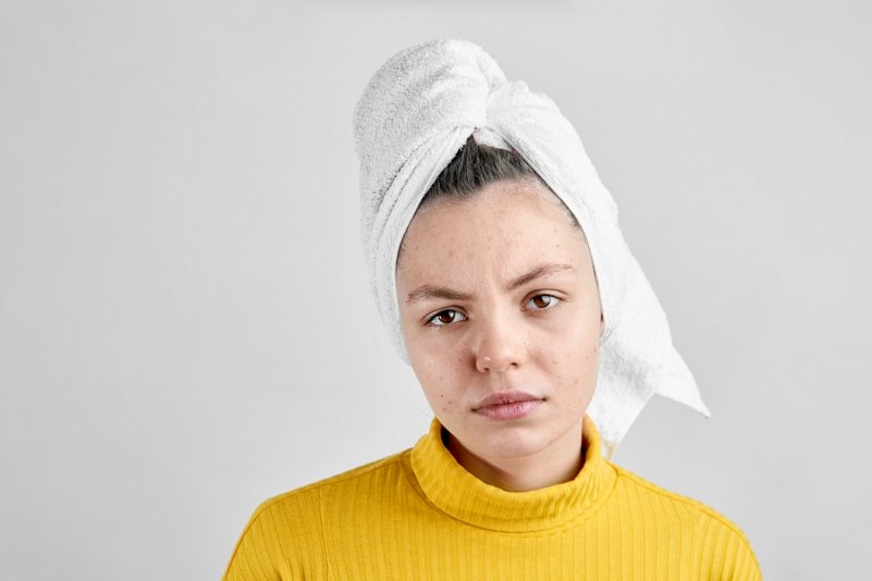 Girl after spa in white towel with acne problem skin puberty period problem