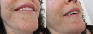 mole moles fotofinder