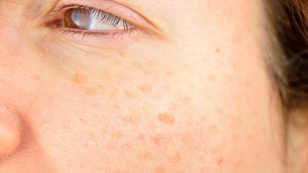 Age And Liver Spots Symptoms Causes And Treatment Toronto Dermatology
