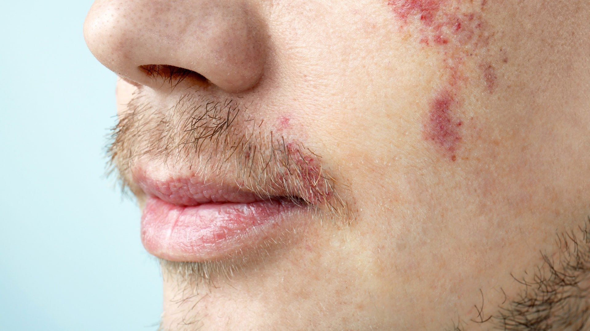 birthmarks-101-what-you-need-to-know-u-s-dermatology-partners