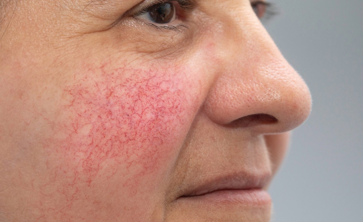 How To Get Rid Of A Blood Vessel On Your Face at Sally Williams blog