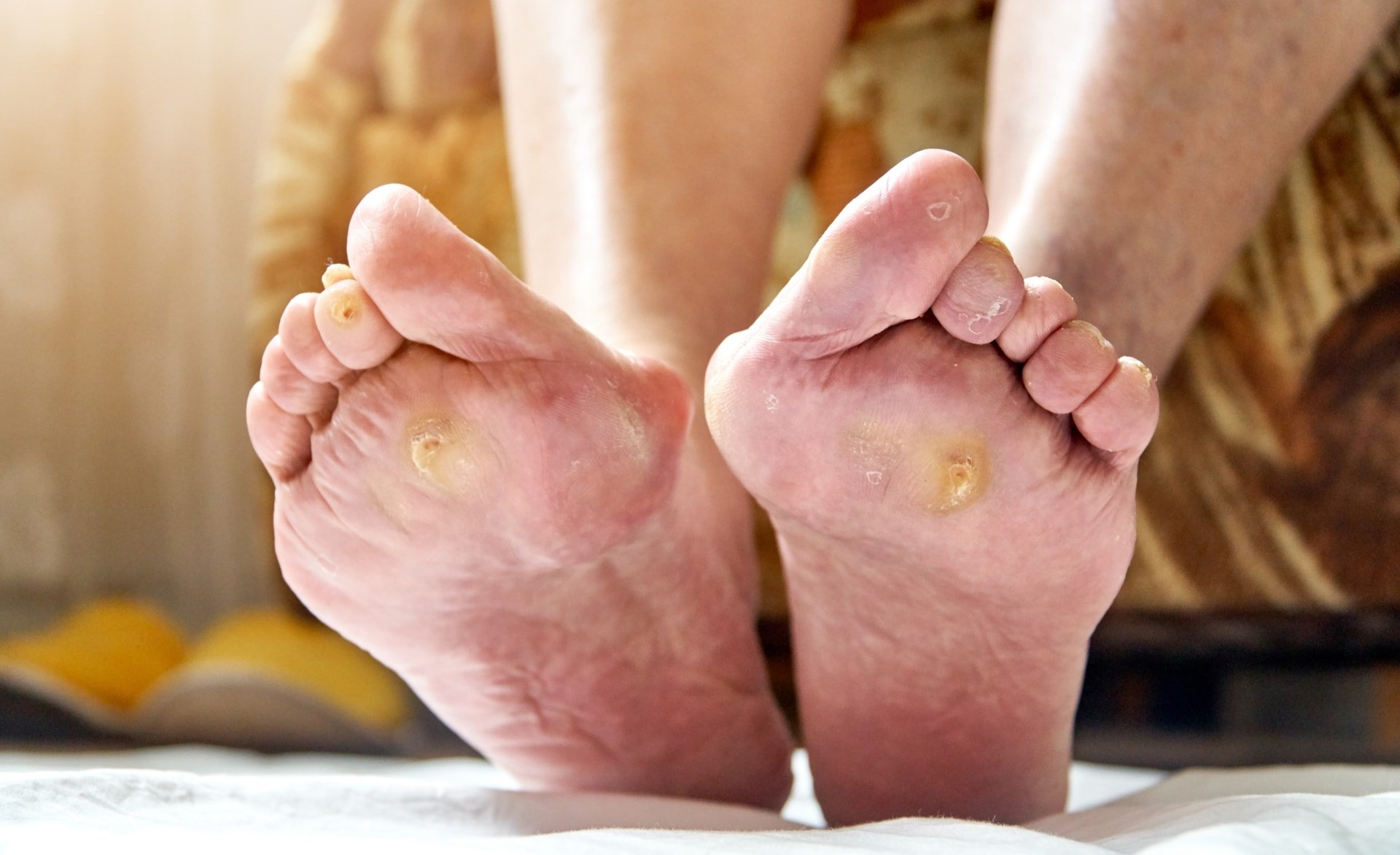 Diabetic Skin Care Toronto Dermatology Centre