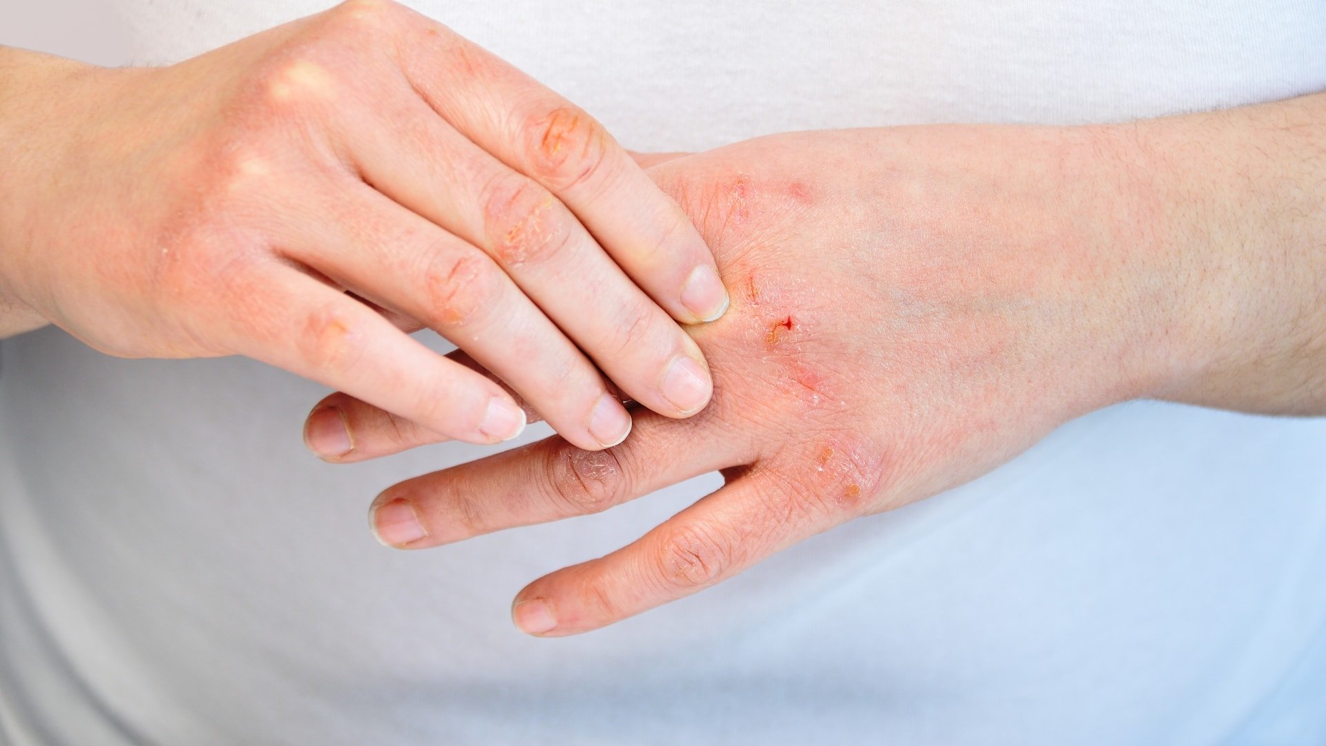 Eczema 