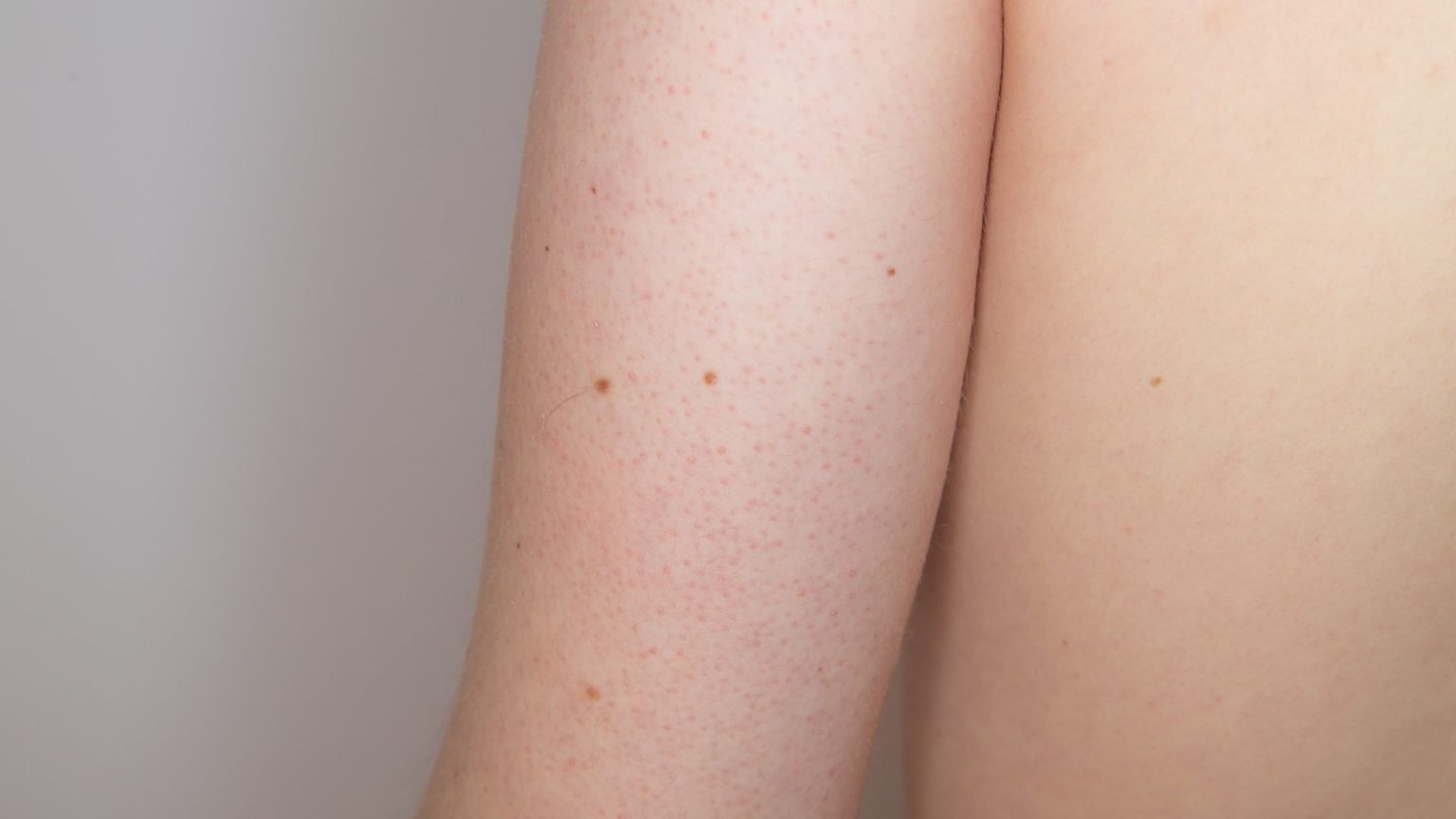 Keratosis Pilaris Diagnosis Causes Treatment Toronto Dermatology Centre