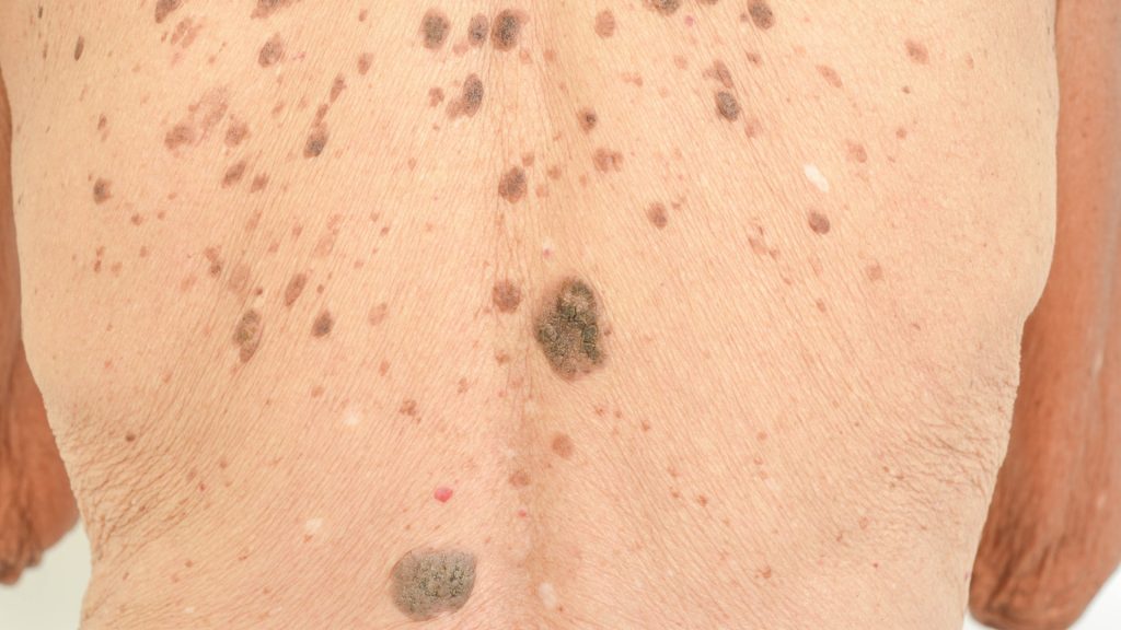 Age And Liver Spots Symptoms Causes And Treatment Toronto Dermatology