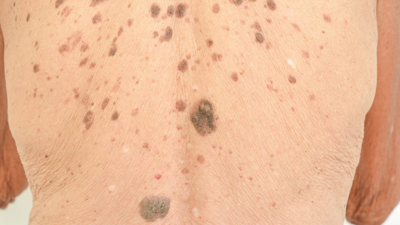 Liver Spots On Body
