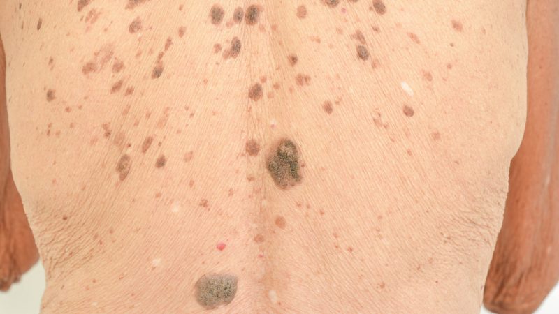 liver-spots-on-body