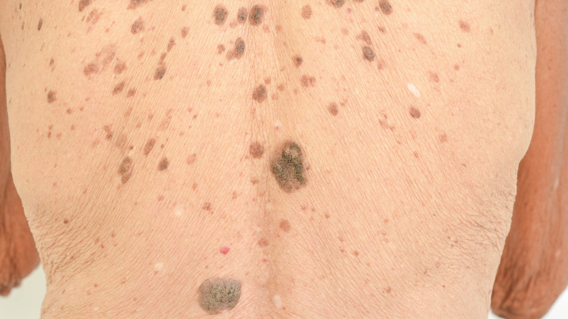 Black Patches Skin Disease at Rachel Hightower blog