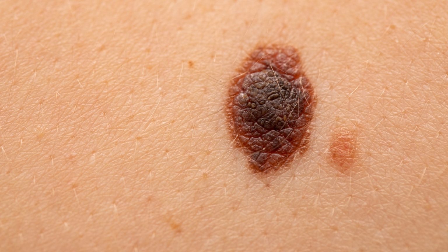 Malignant Melanoma (MM)