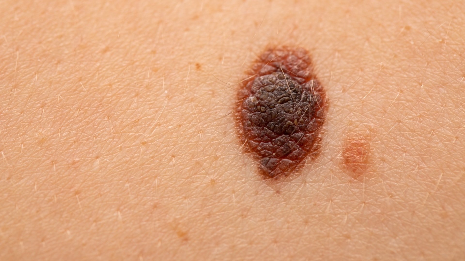 Wat is melanoom huidkanker?