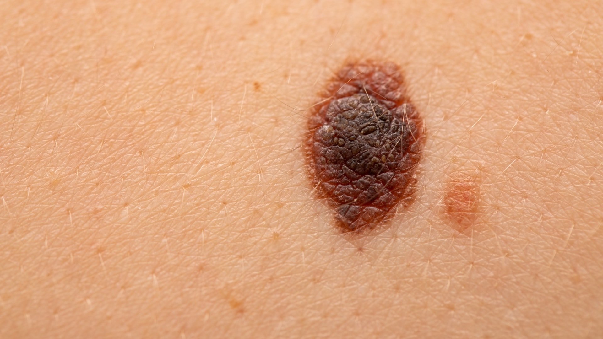 Malignant Melanoma MM 