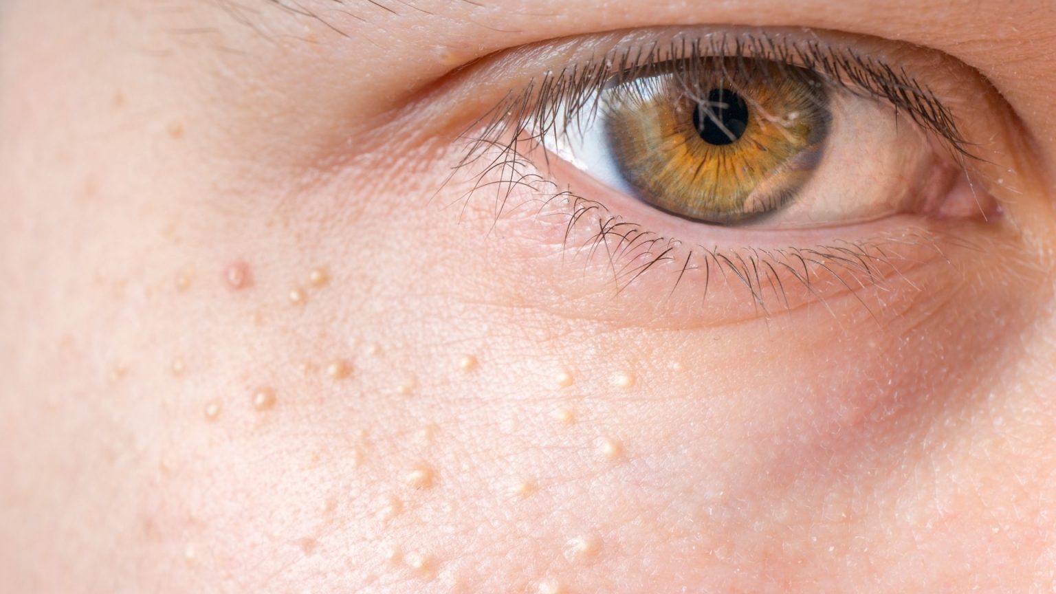 Milia Cysts Symptoms, Causes, & Treatment Toronto Dermatology Centre