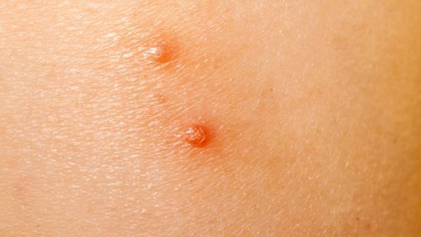 Molluscum Contagiosum: Symptoms, Causes, & Treatment - Toronto ...