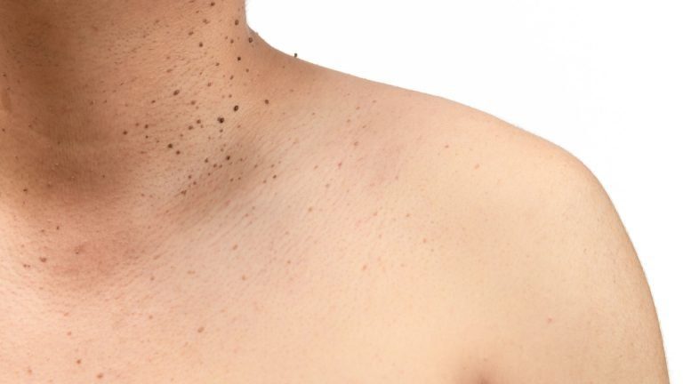 Skin Tag Removal & Treatment - Toronto Dermatology Centre