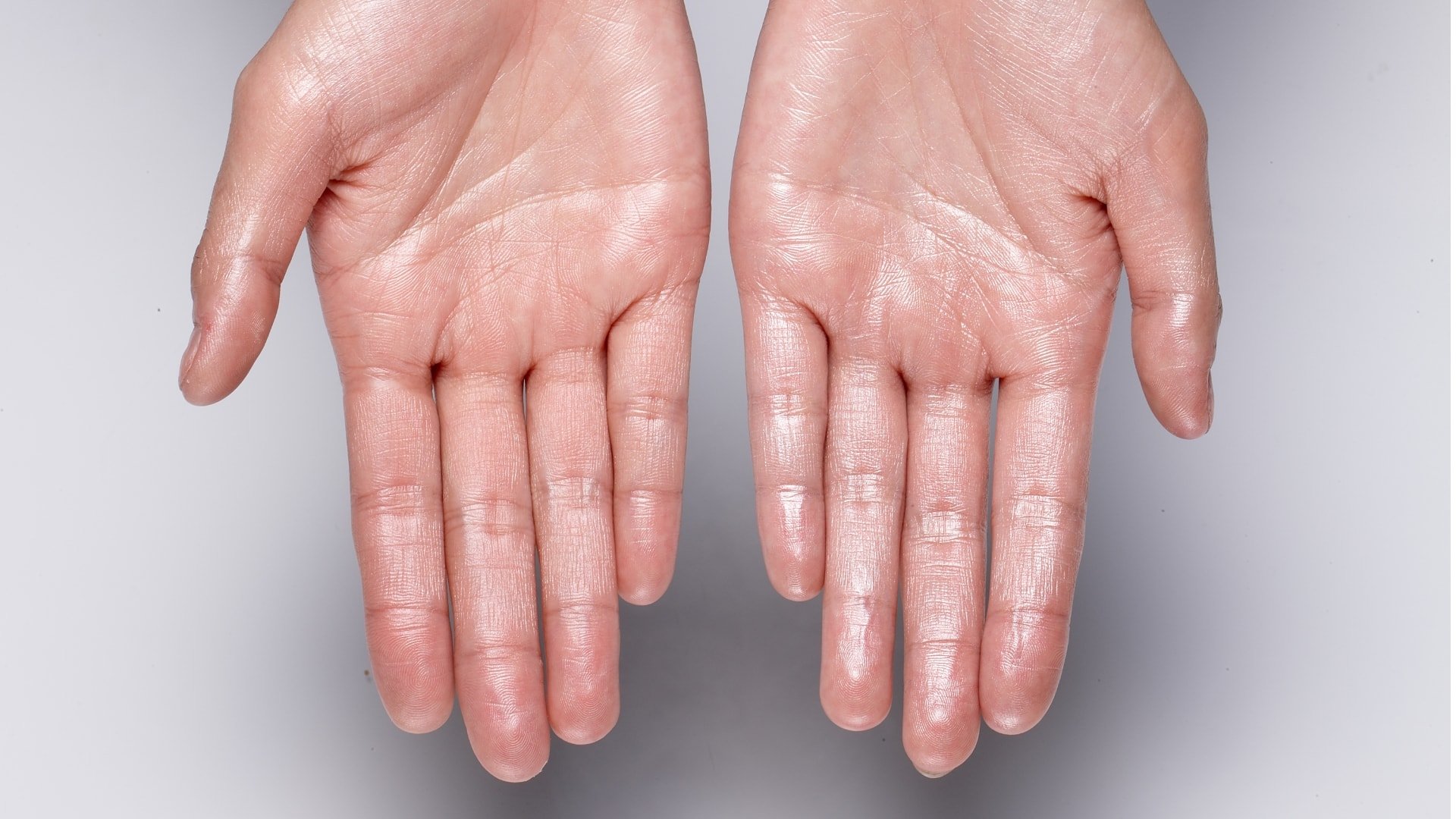 hyperhidrosis-toronto-excess-local-sweating-treatment-clinic