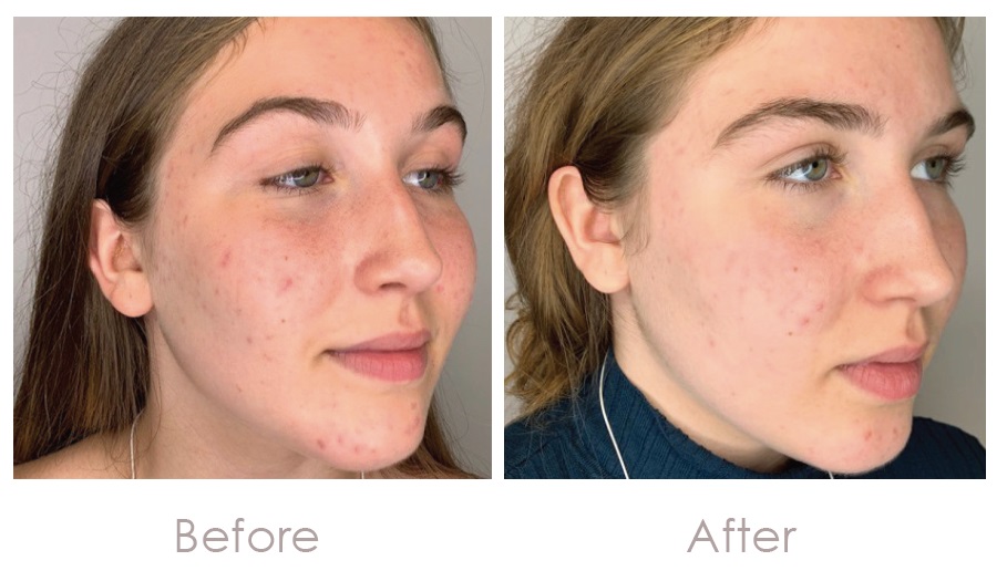 bClear Before and After Results
