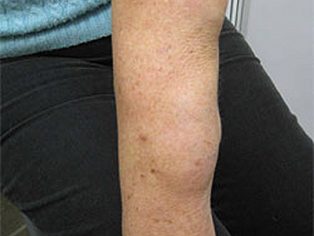 Lipoma 2