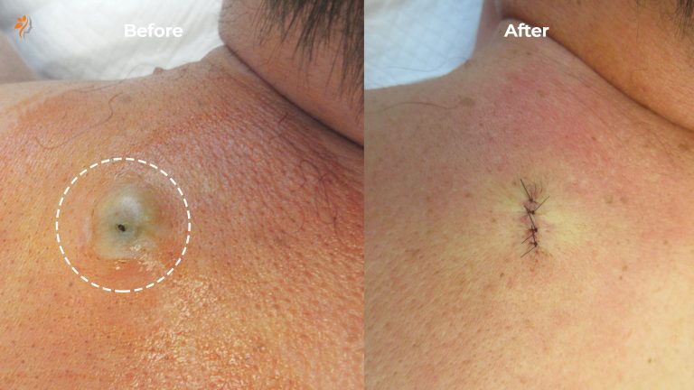 Epidermoid Cysts: Diagnosis, Causes, & Treatment - Toronto Dermatology ...