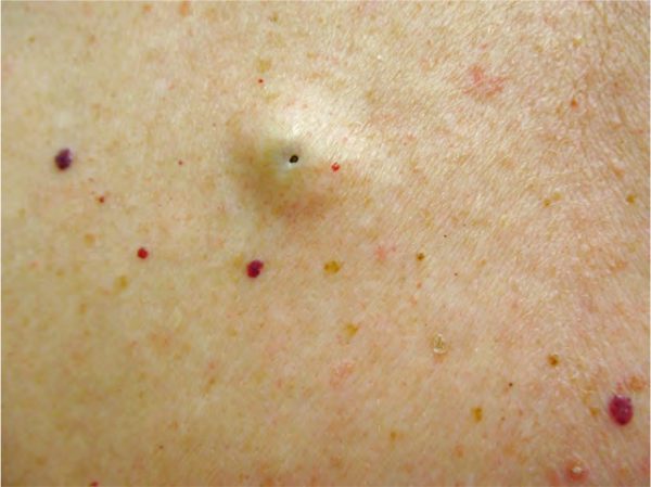 Epidermoid Cysts Diagnosis Causes And Treatment Toronto Dermatology Centre