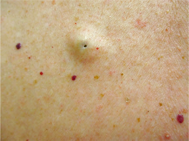 Epidermoid Cysts Diagnosis Causes And Treatment Toronto Dermatology